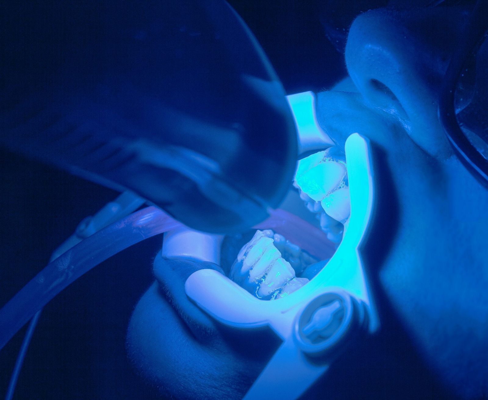 Blanchiment dentaire professionnel au cabinet dental eden